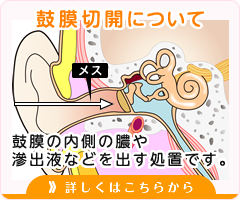 鼓膜切開について 鼓膜の内側の膿や滲出液などを出す処置です。 詳しくはこちらから